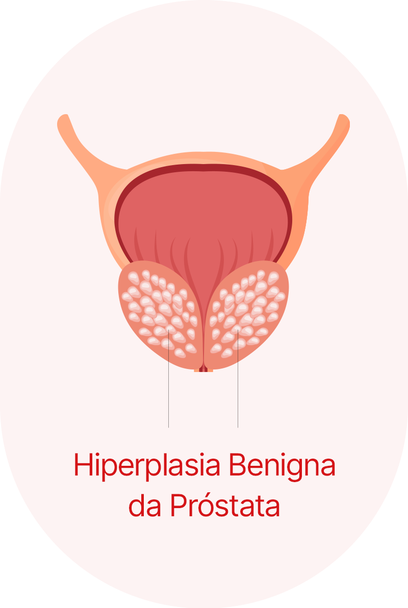 Hiperplasia Benigna da Próstata
